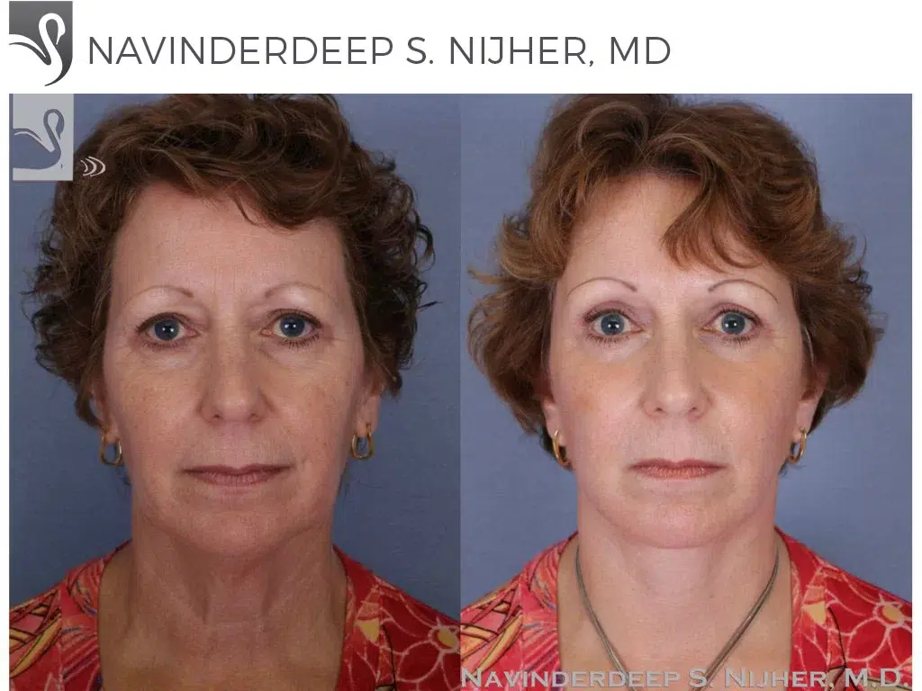Before and After Image: Brow Lift Case #51160 - front