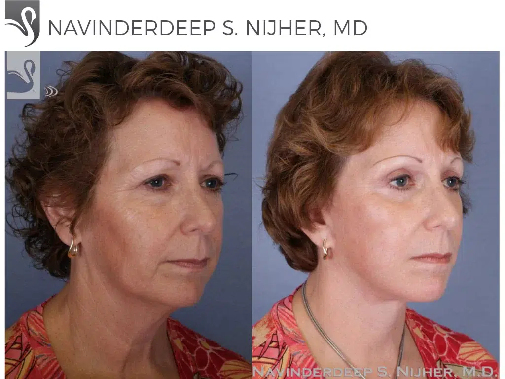 Before and After Image: Brow Lift Case #51160 - right-front-oblique