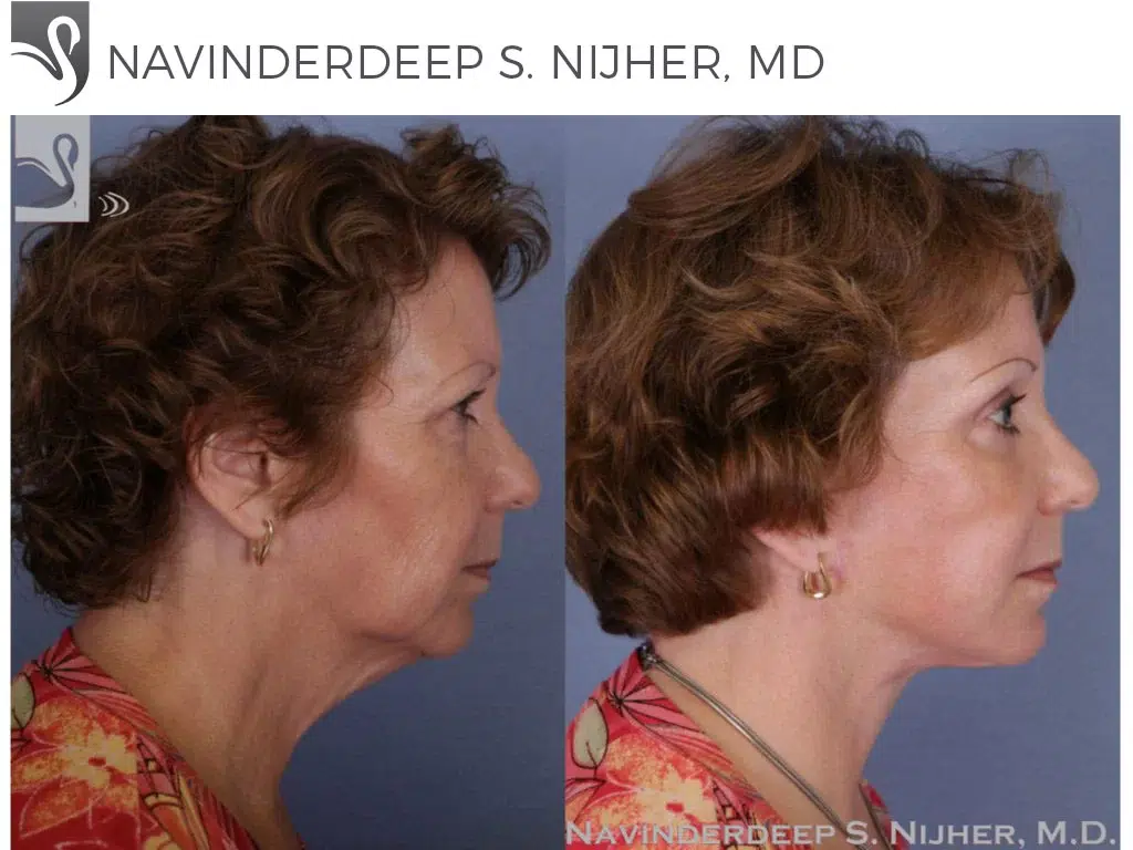 Before and After Image: Brow Lift Case #51160 - right-side