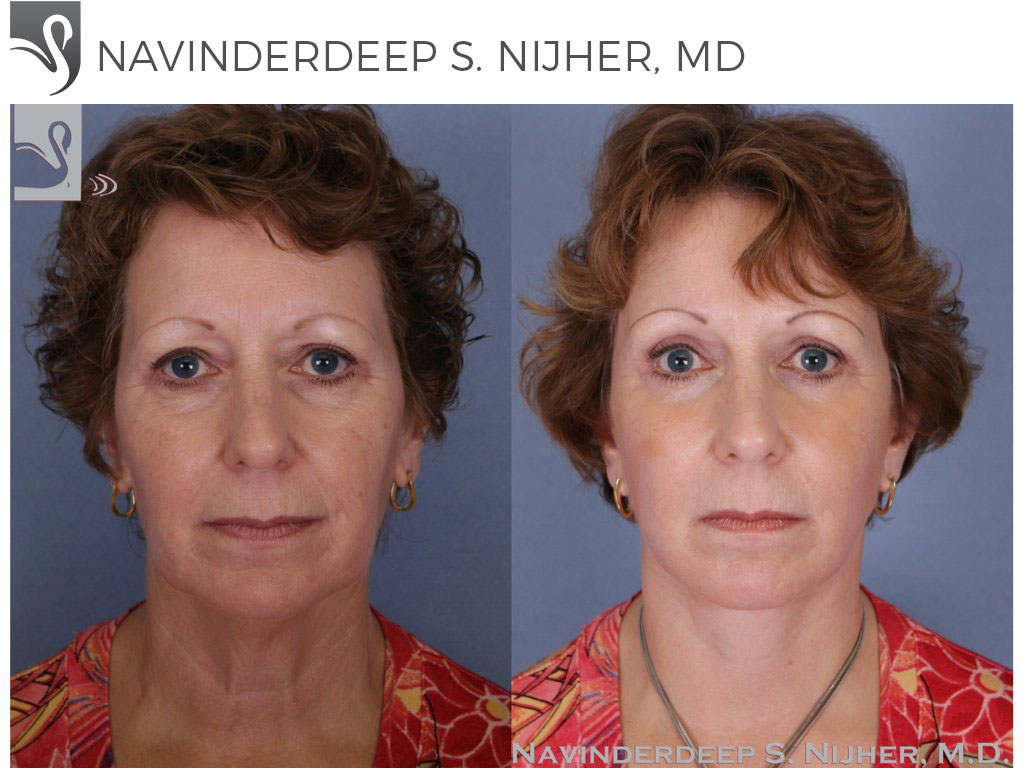 Before and After Image: Face Lift Case #51160 - front