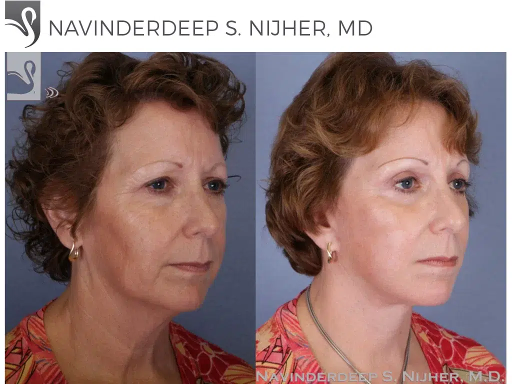 Before and After Image: Face Lift Case #51160 - right-front-oblique