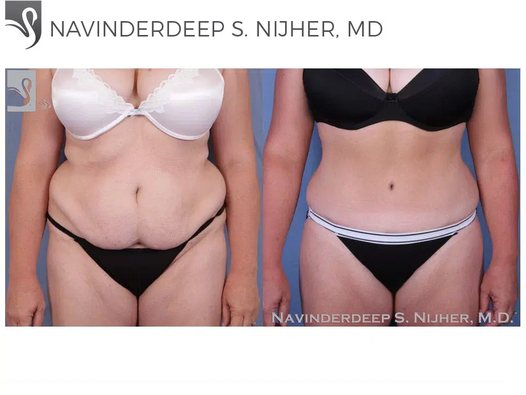 Before and After Image: Abdominoplasty (Tummy Tuck) Case #51313 - front