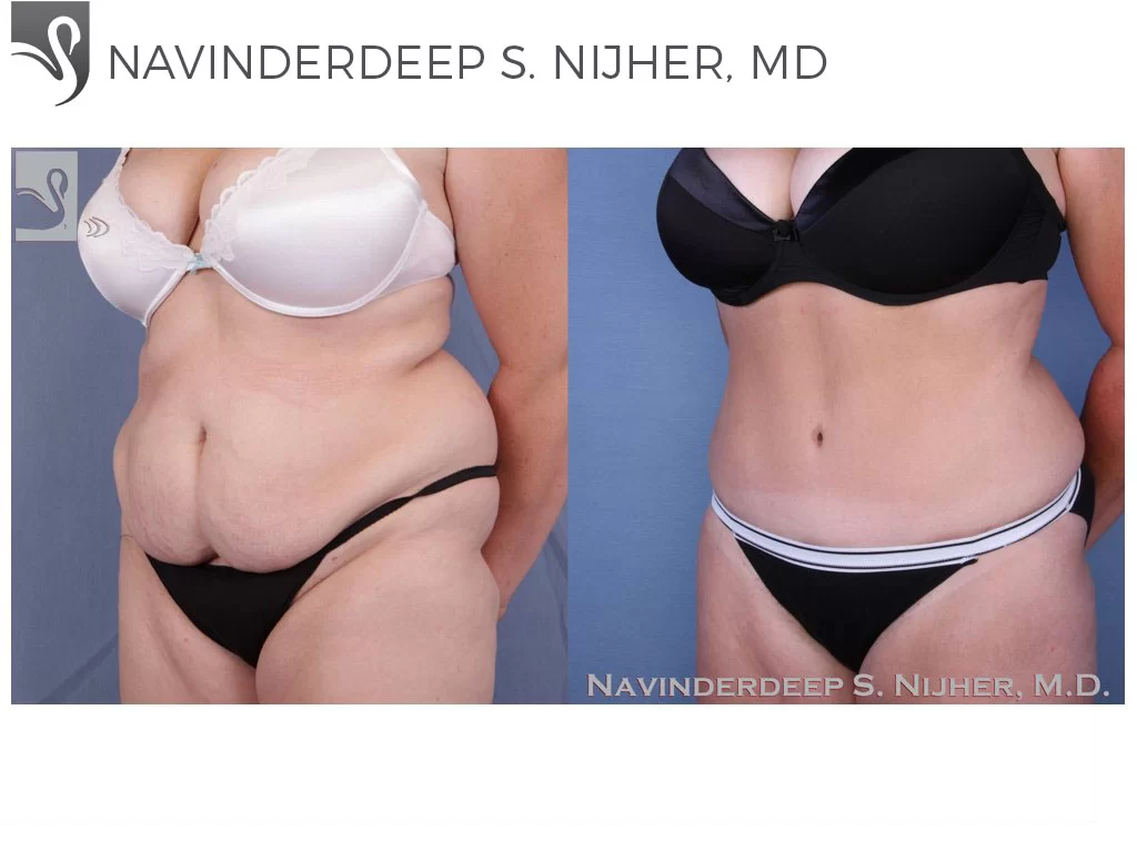 Before and After Image: Abdominoplasty (Tummy Tuck) Case #51313 - left-front-oblique