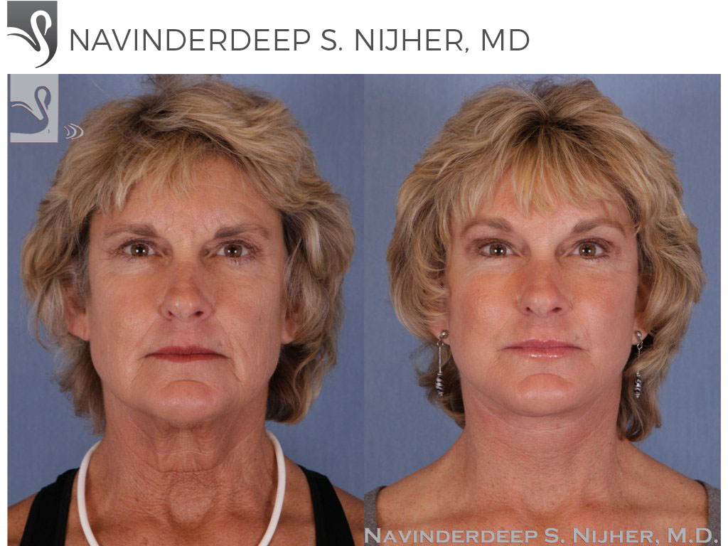 Before and After Image: Brow Lift Case #51329 - front