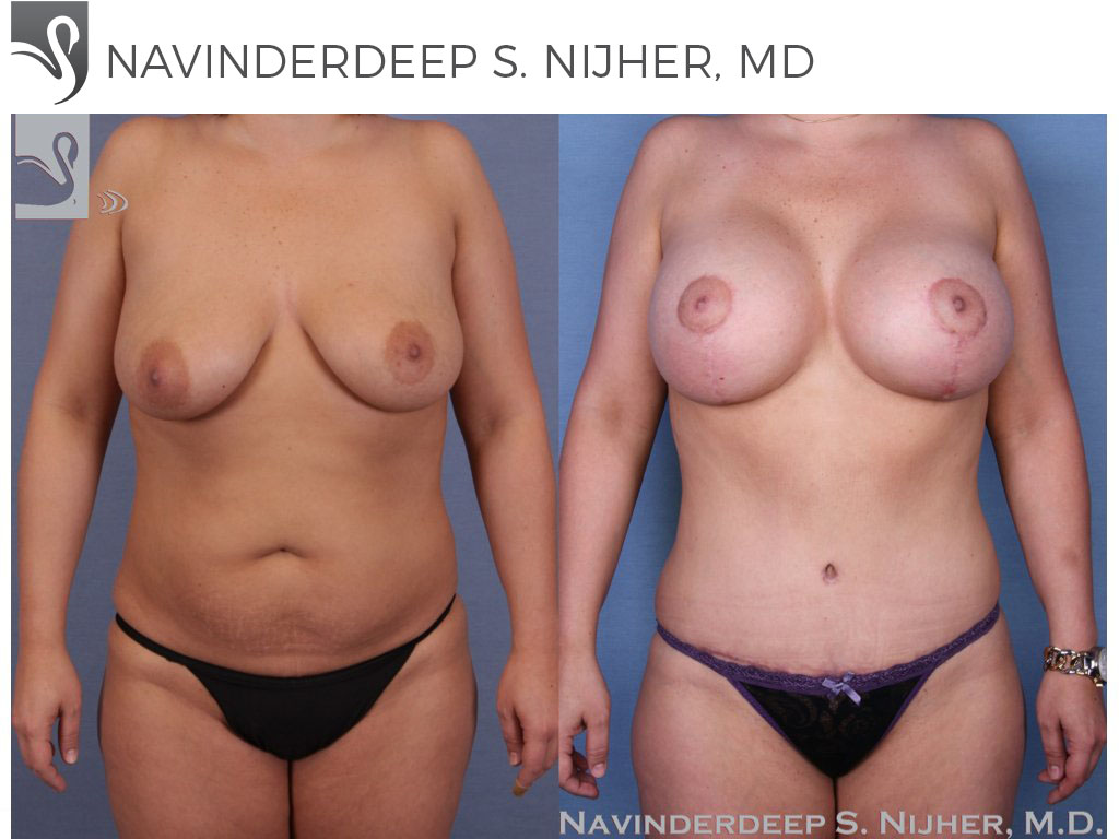 Before and After Image: Mommy Makeover Case #51344 - front