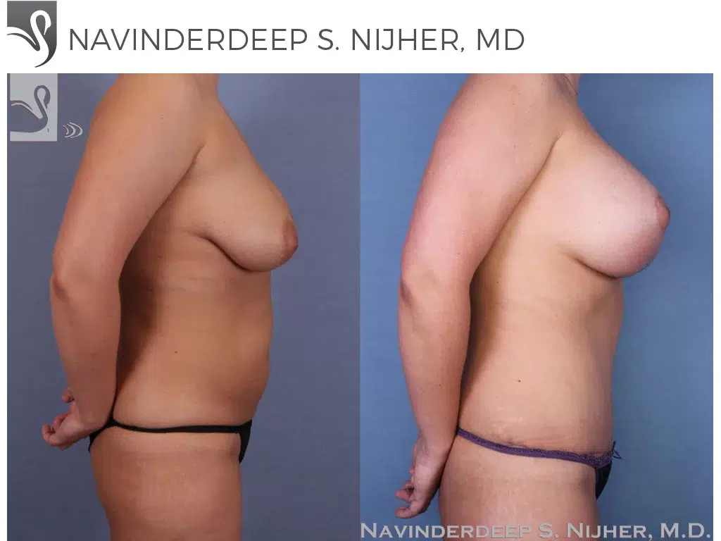 Before and After Image: Mommy Makeover Case #51344 - right-side