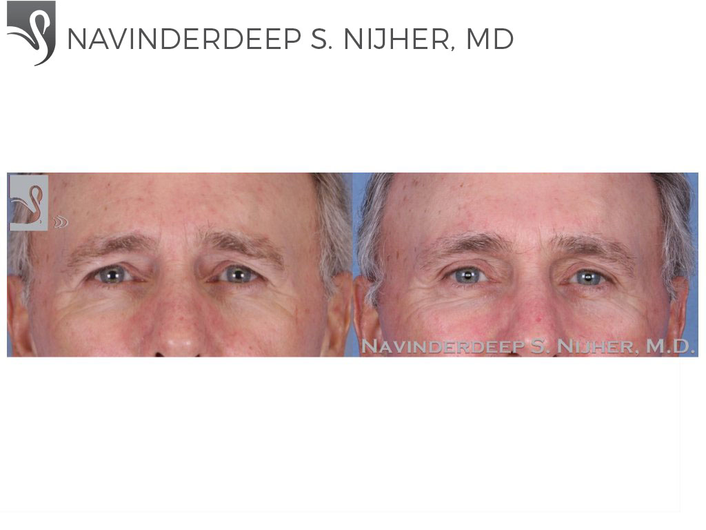 Before and After Image: Eyelid Surgery Case #51540 - front