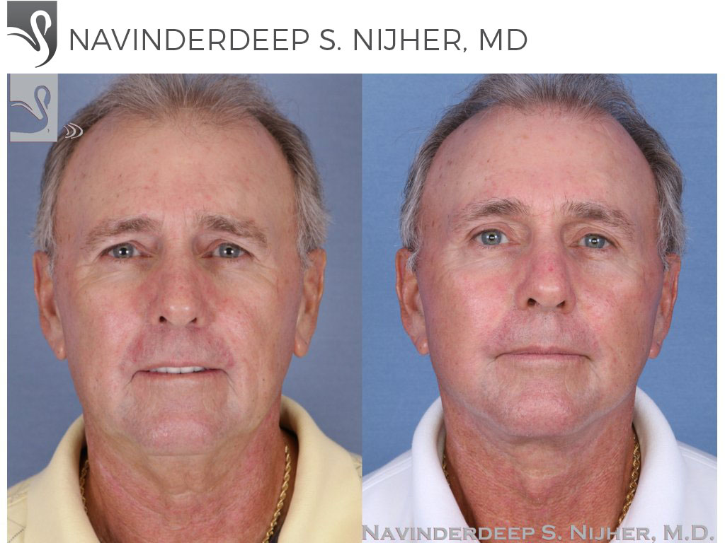 Before and After Image: Face Lift Case #51540 - front