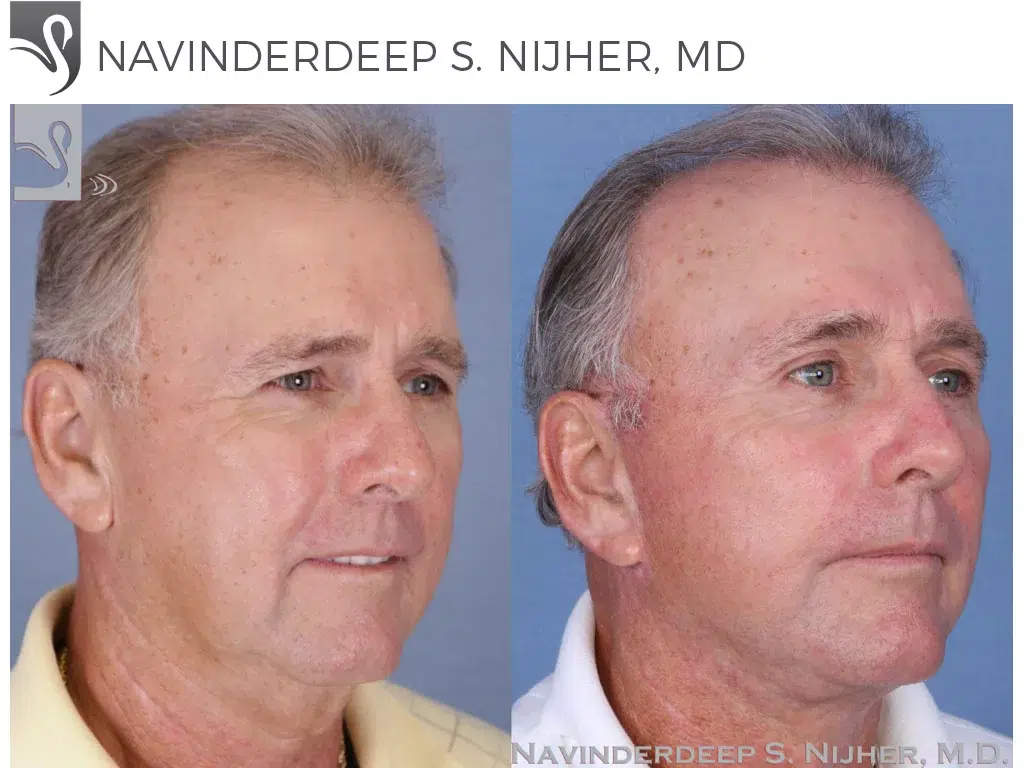 Before and After Image: Face Lift Case #51540 - right-front-oblique