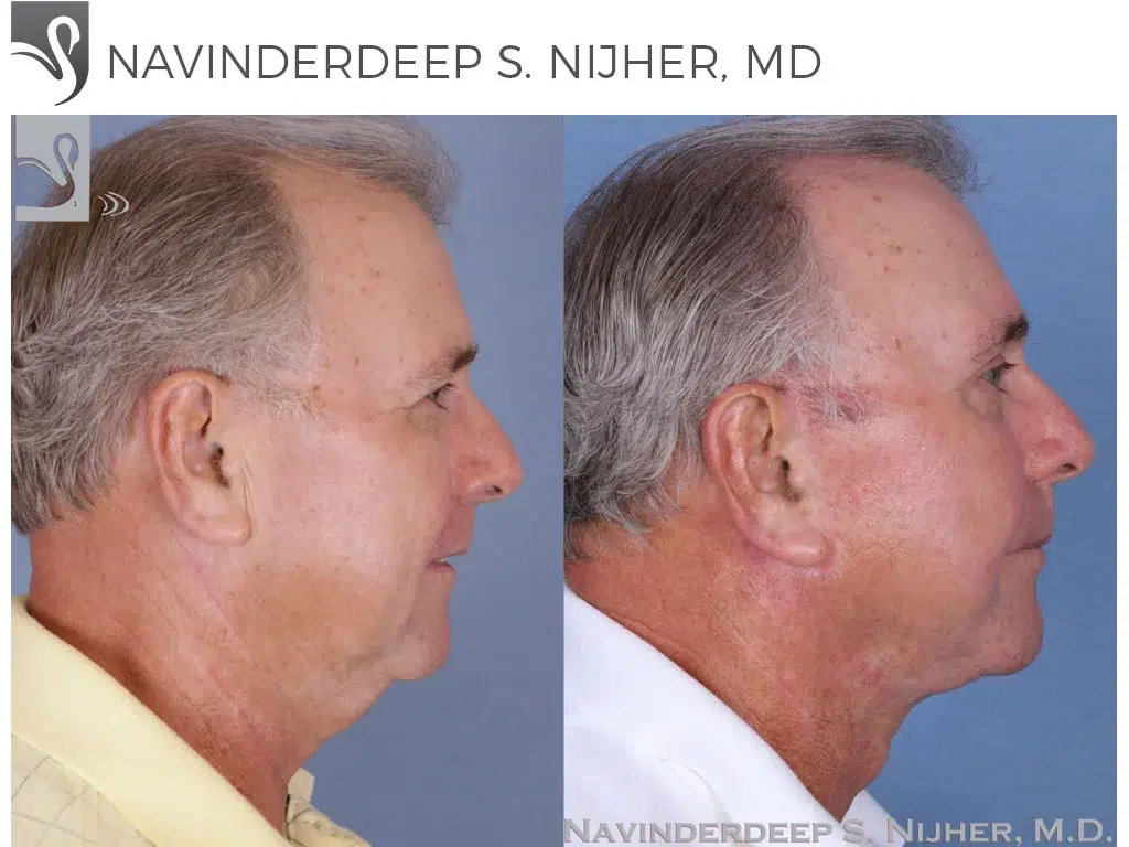 Before and After Image: Face Lift Case #51540 - right-side