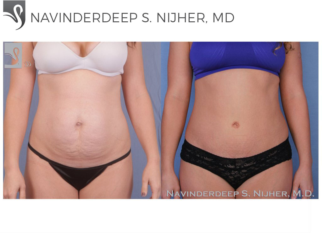 Before and After Image: Abdominoplasty (Tummy Tuck) Case #51579 - front