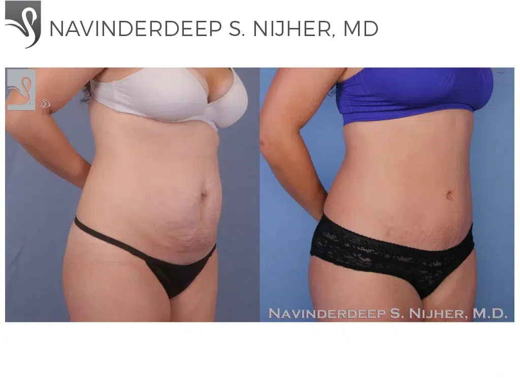 Before and After Image: Abdominoplasty (Tummy Tuck) Case #51579 - right-front-oblique