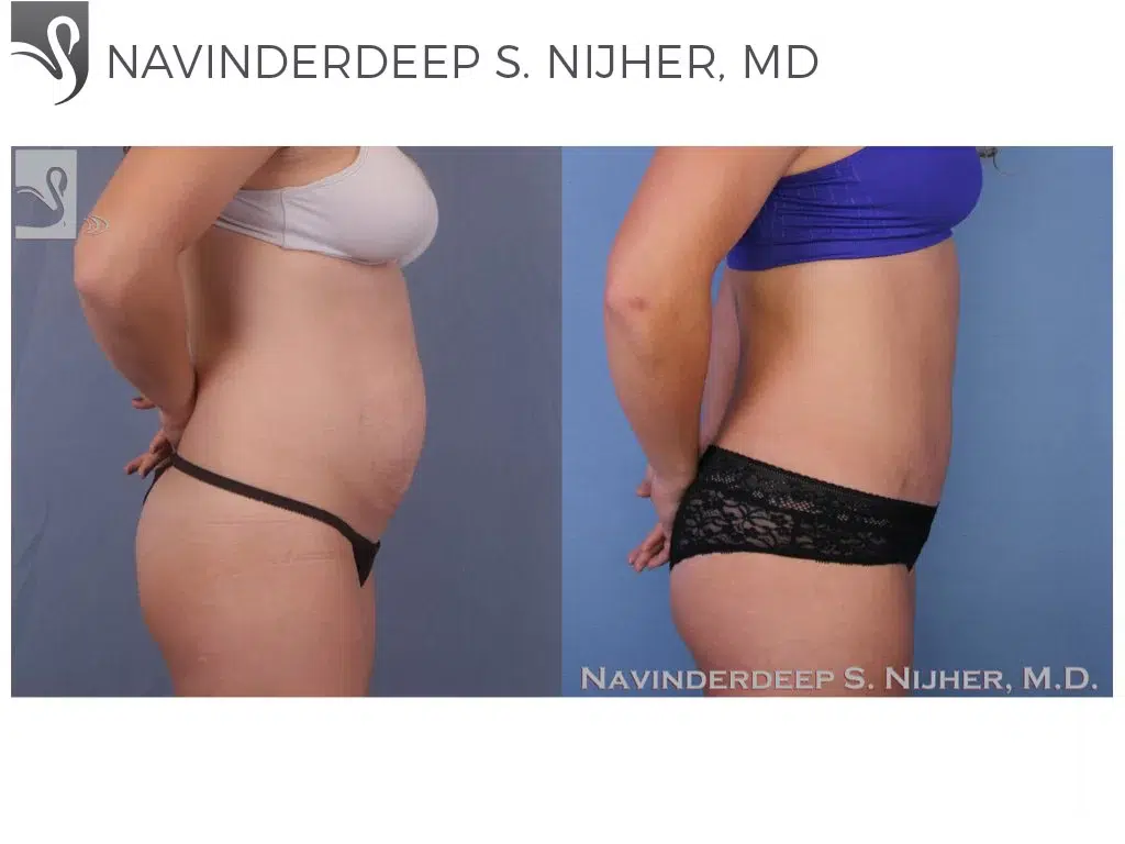 Before and After Image: Abdominoplasty (Tummy Tuck) Case #51579 - right-side