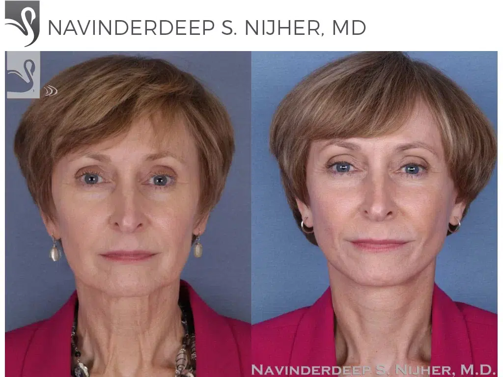 Before and After Image: Face Lift Case #51871 - front