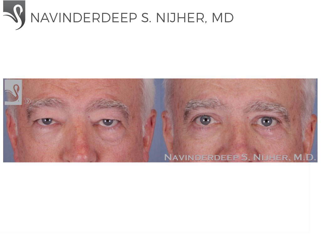 Before and After Image: Eyelid Surgery Case #51894 - front
