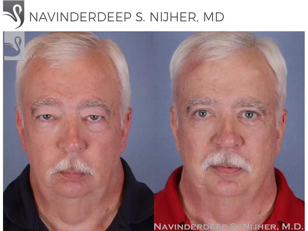 Before and After Image: Brow Lift Case #51894