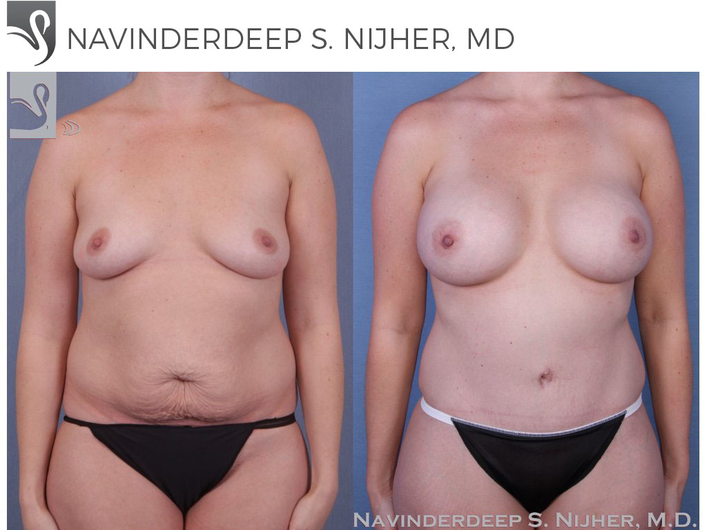Before and After Image: Mommy Makeover Case #51897 - front