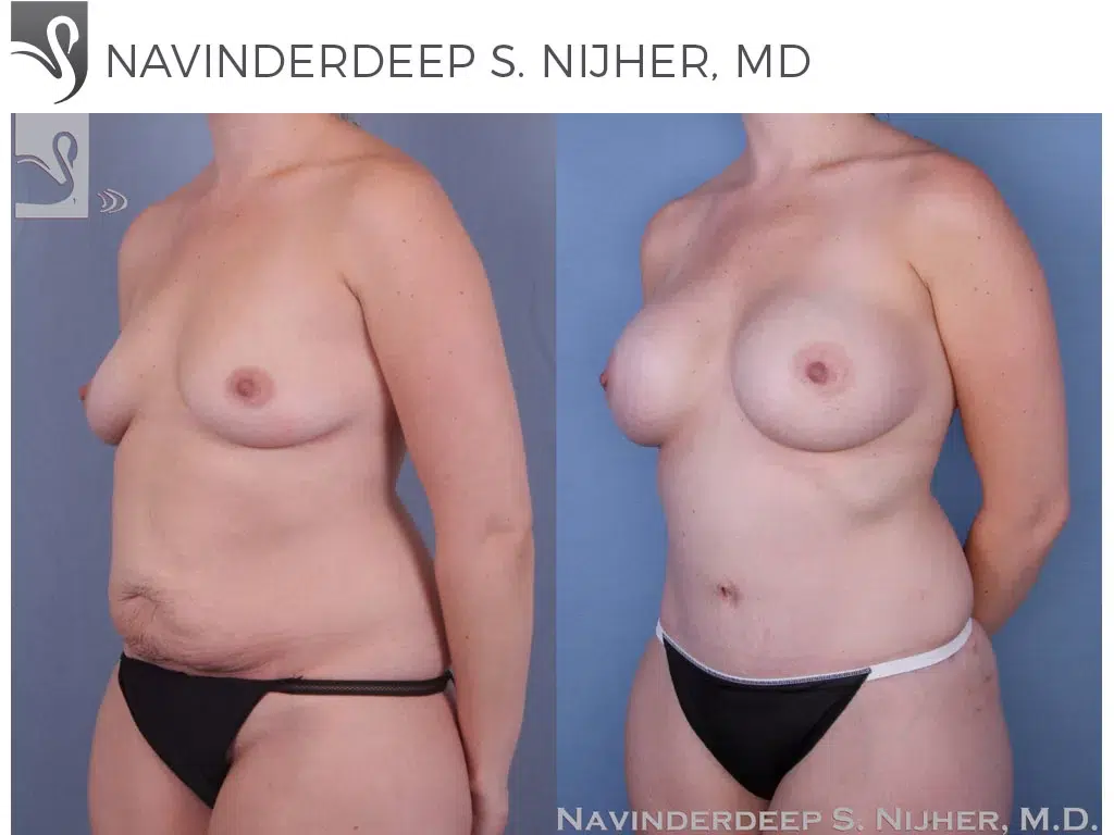 Before and After Image: Mommy Makeover Case #51897 - left-front-oblique