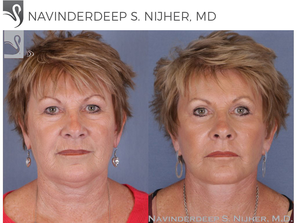 Before and After Image: Face Lift Case #52089 - front