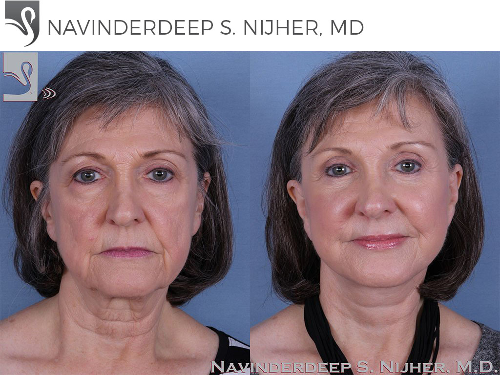 Before and After Image: Face Lift Case #52091 - front