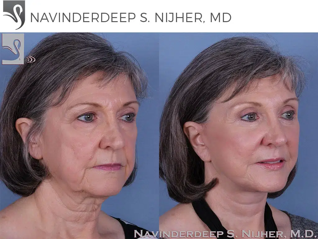 Before and After Image: Face Lift Case #52091 - right-front-oblique