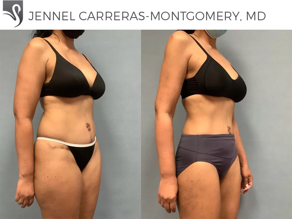 Before and After Image: Liposuction Case #52267 - right-front-oblique