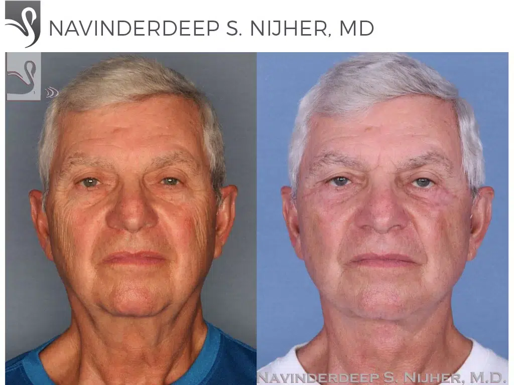 Before and After Image: Face Lift Case #52272 - front