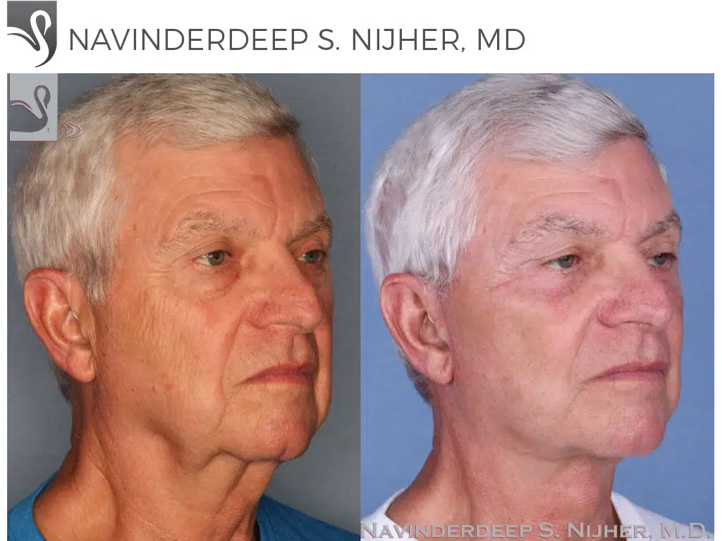 Before and After Image: Face Lift Case #52272 - right-front-oblique