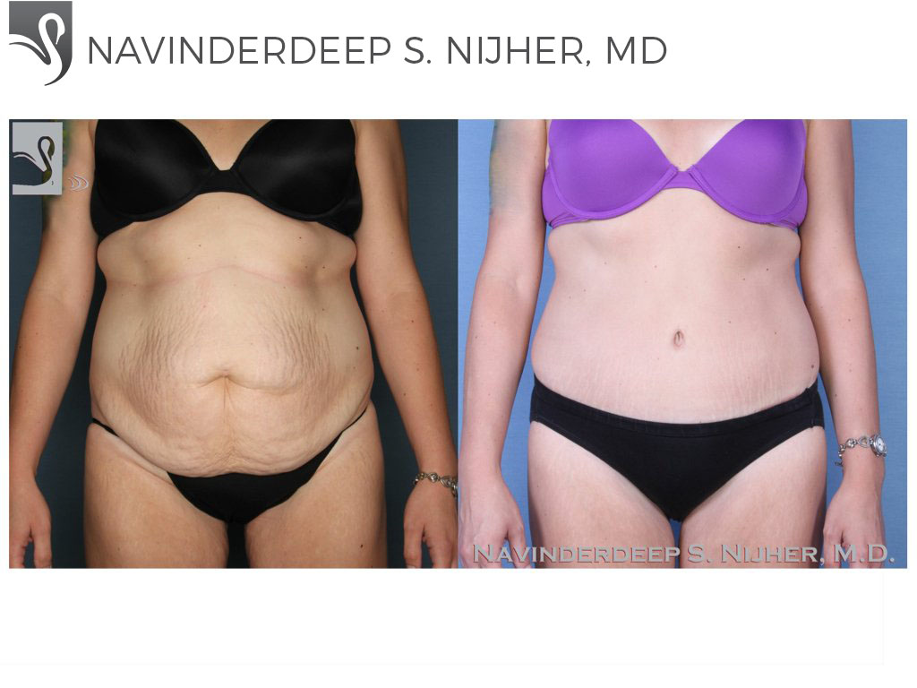Before and After Image: Abdominoplasty (Tummy Tuck) Case #52275 - front