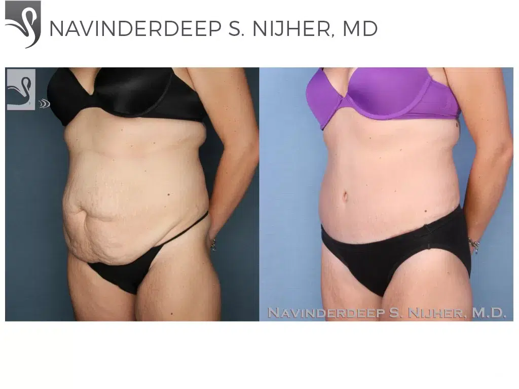 Before and After Image: Abdominoplasty (Tummy Tuck) Case #52275 - left-front-oblique