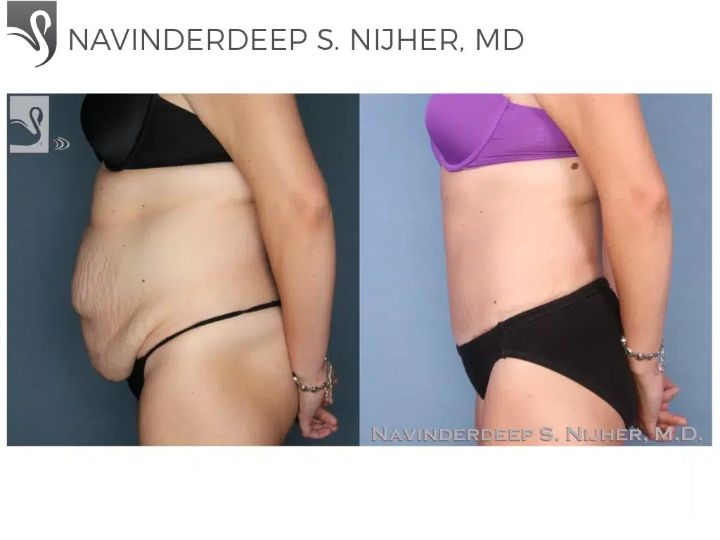 Before and After Image: Abdominoplasty (Tummy Tuck) Case #52275 - left-side