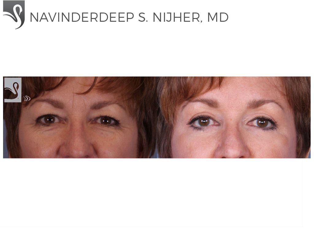 Before and After Image: Eyelid Surgery Case #52348 - front
