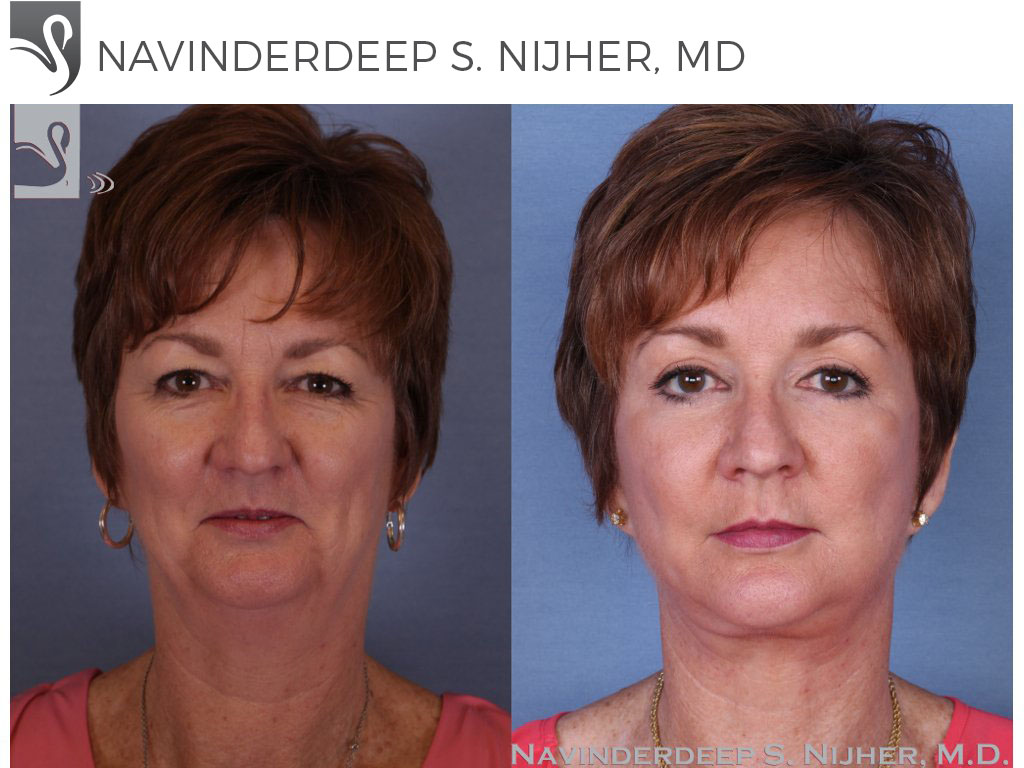 Before and After Image: Face Lift Case #52348 - front