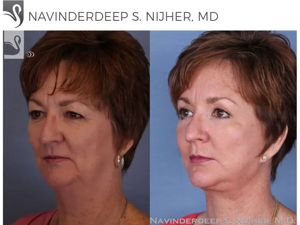 Before and After Image: Face Lift Case #52348 - left-front-oblique