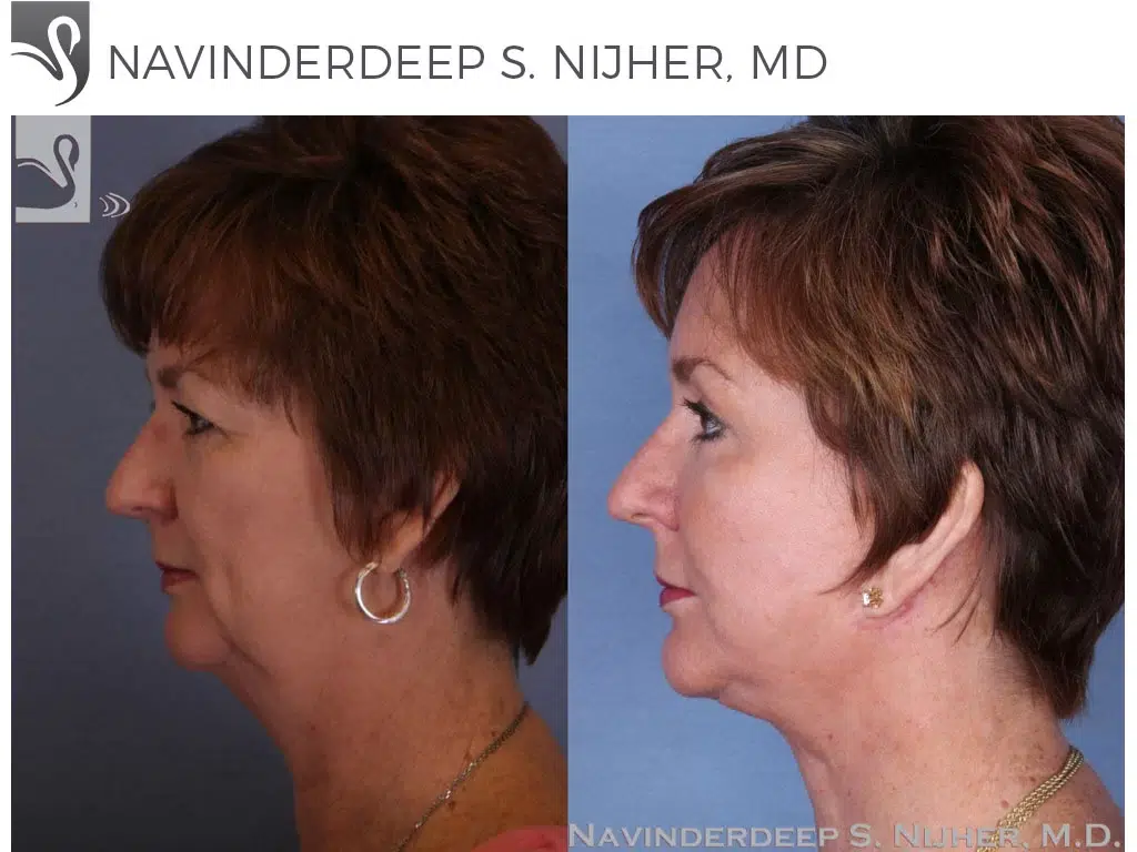 Before and After Image: Face Lift Case #52348 - left-side