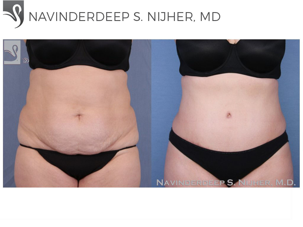 Before and After Image: Abdominoplasty (Tummy Tuck) Case #52373 - front