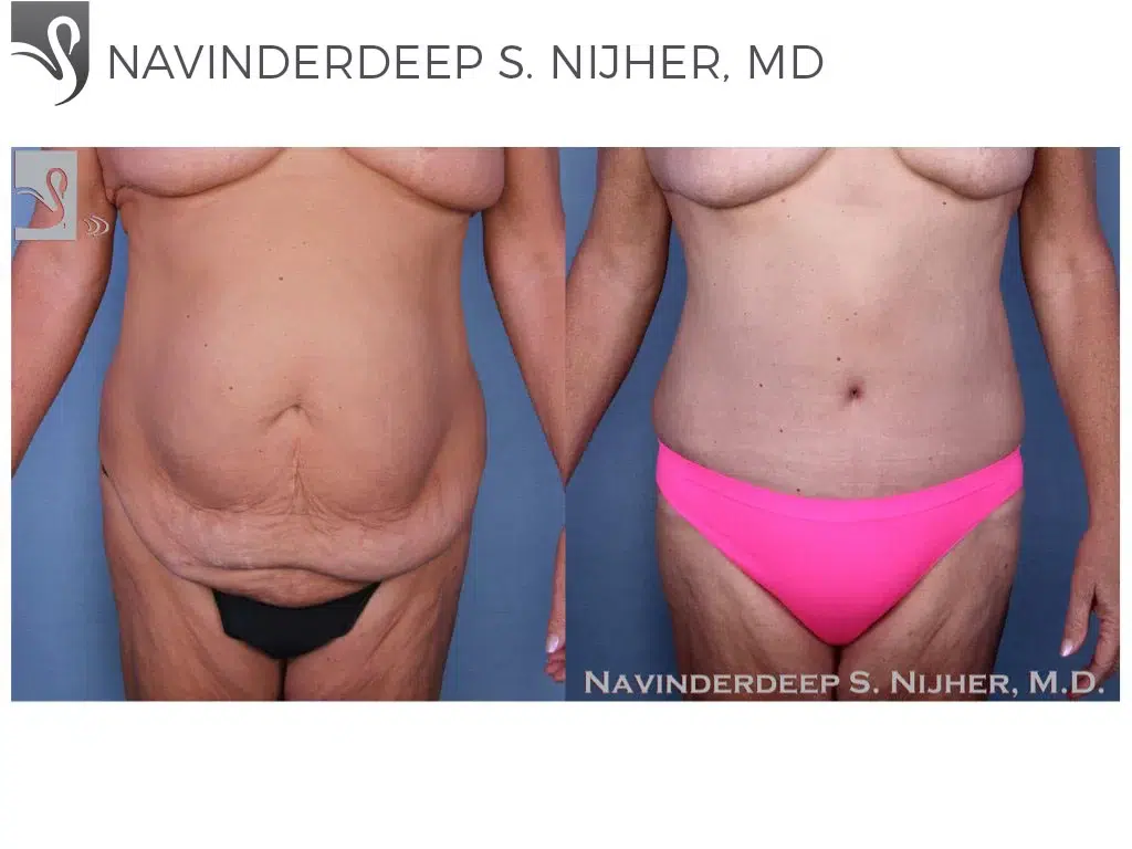 Before and After Image: Abdominoplasty (Tummy Tuck) Case #52534 - front