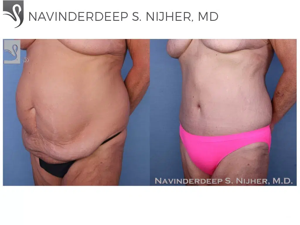 Before and After Image: Abdominoplasty (Tummy Tuck) Case #52534 - left-front-oblique