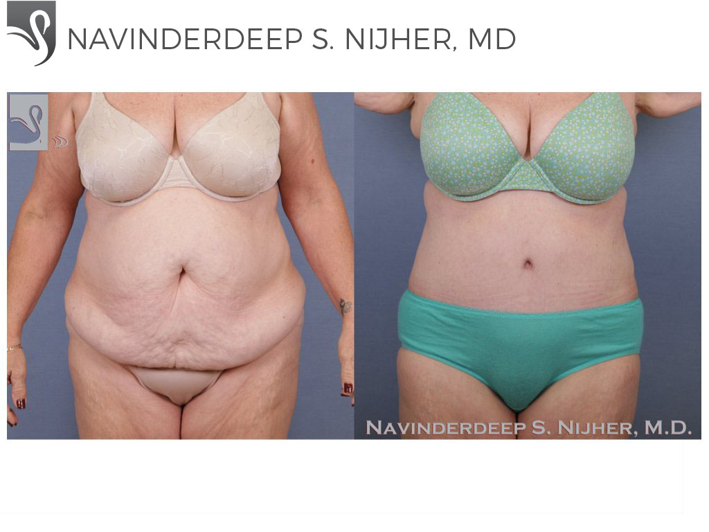 Before and After Image: Abdominoplasty (Tummy Tuck) Case #52573 - front