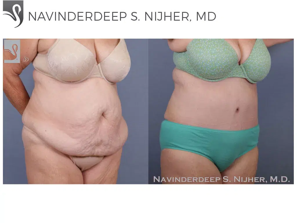 Before and After Image: Abdominoplasty (Tummy Tuck) Case #52573 - right-front-oblique