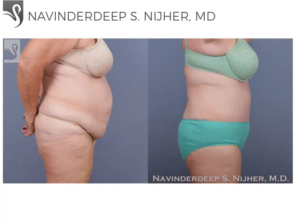 Before and After Image: Abdominoplasty (Tummy Tuck) Case #52573 - right-side