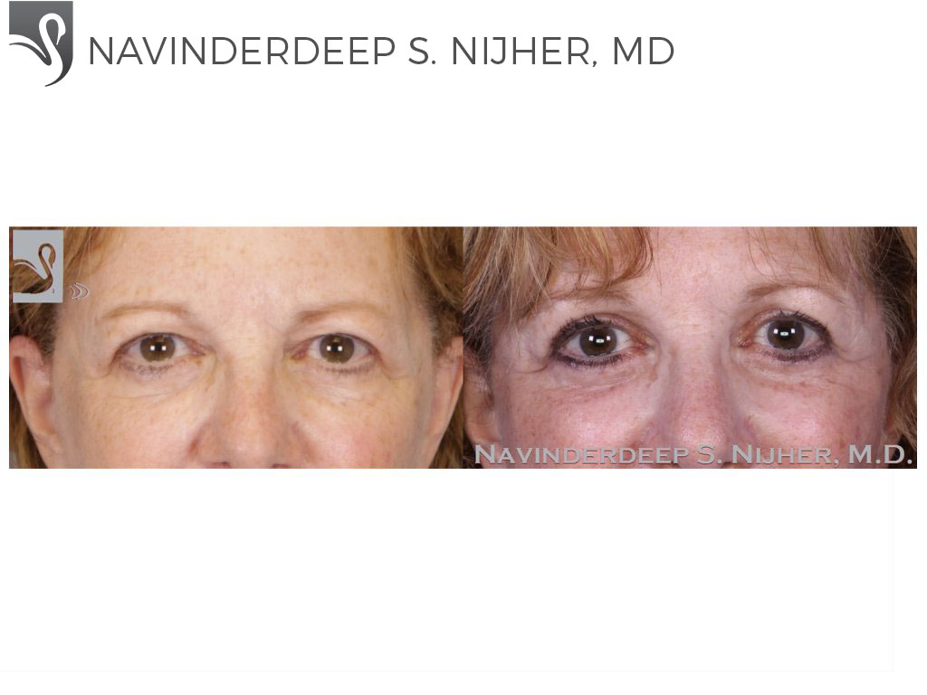 Before and After Image: Eyelid Surgery Case #52651 - front