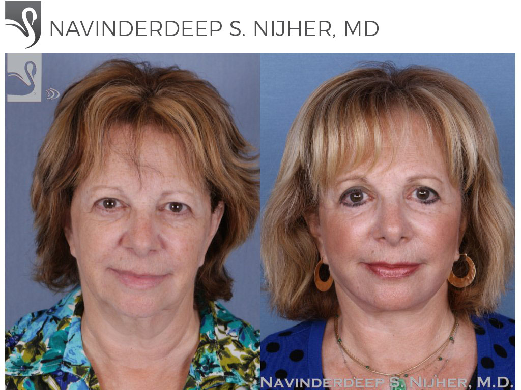 Before and After Image: Face Lift Case #52651 - front