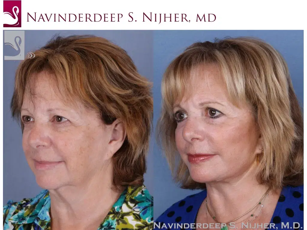 Before and After Image: Face Lift Case #52651 - left-front-oblique