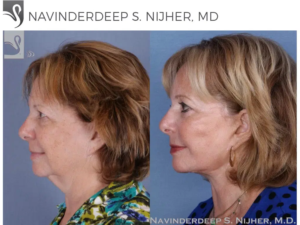 Before and After Image: Face Lift Case #52651 - left-side
