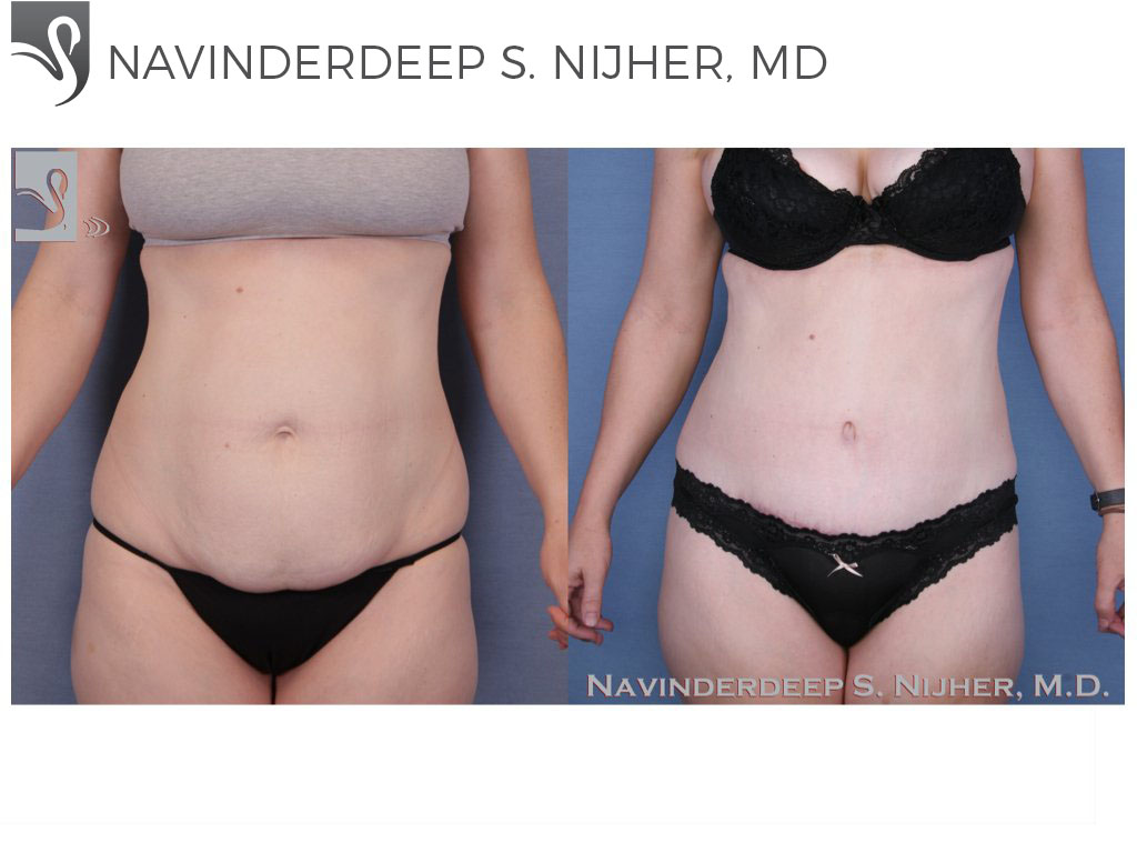 Before and After Image: Abdominoplasty (Tummy Tuck) Case #52653 - front