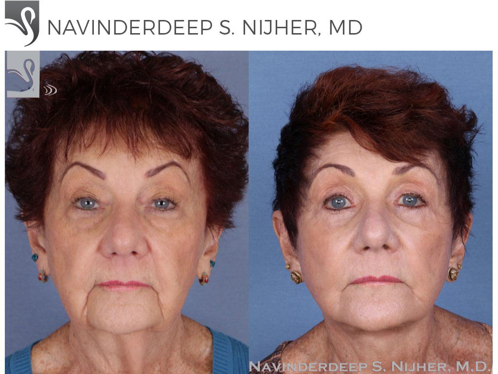 Before and After Image: Face Lift Case #52784 - front