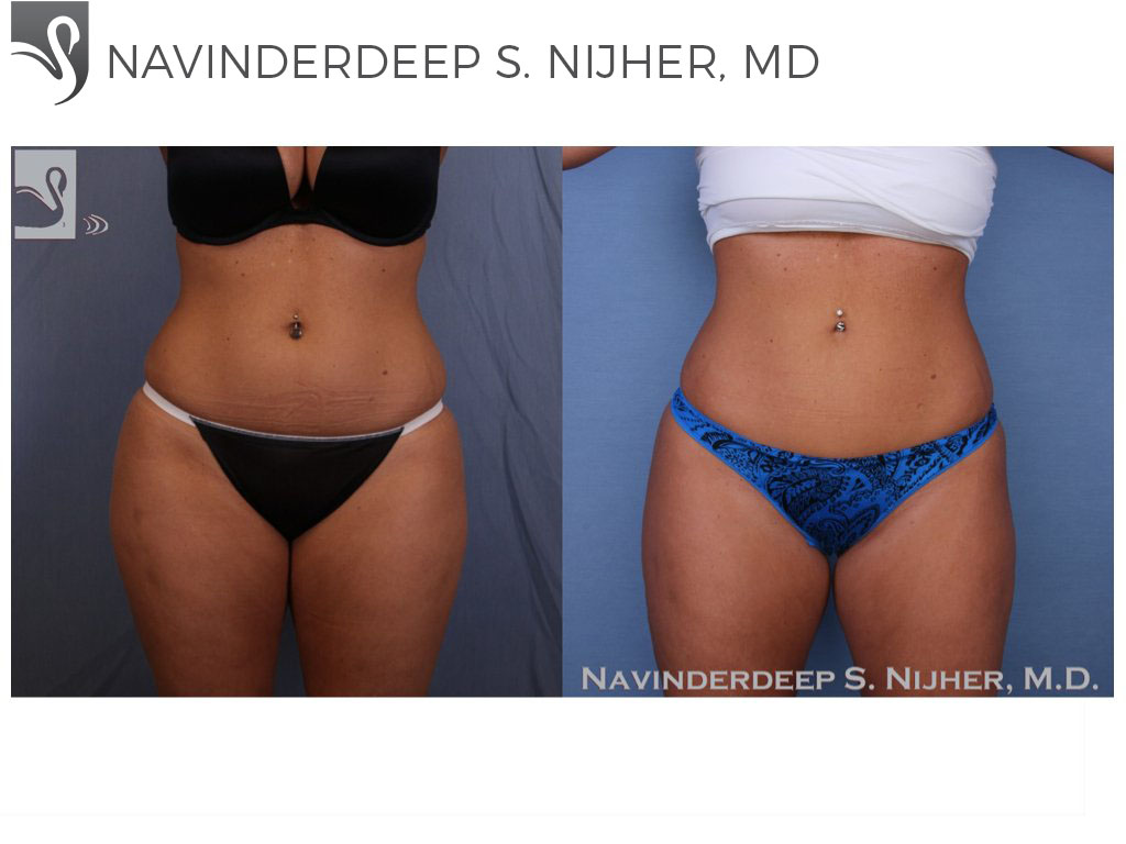 Before and After Image: Liposuction Case #53117 - front