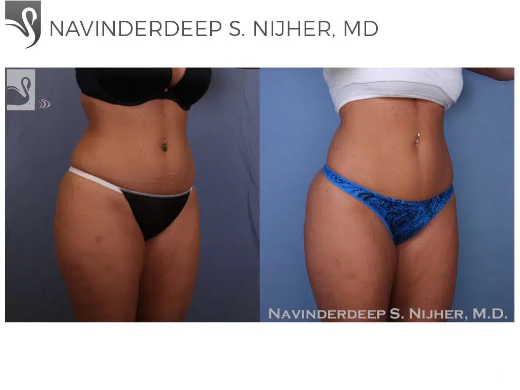 Before and After Image: Liposuction Case #53117 - right-front-oblique