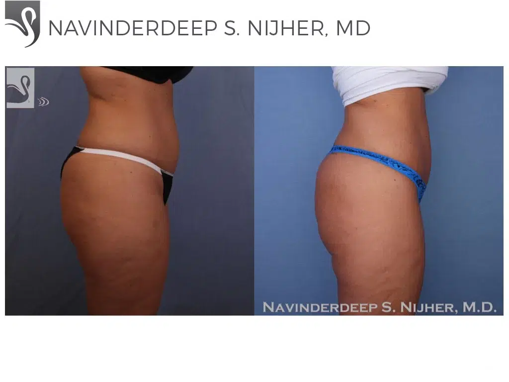 Before and After Image: Liposuction Case #53117 - right-side